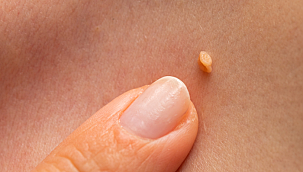 Evdeki çözüm yoluyla siğillerden kurtulmanın kolay yolu!