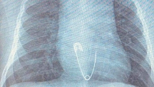 5 aylık bebeğin yuttuğu çengelli iğne soluk borusuna saplandı!