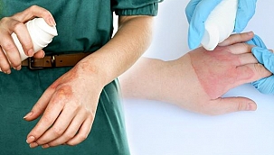 Ateş yanığına ne iyi gelir? Yanık için doğal tedavi yöntemleri...