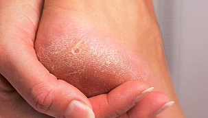 Bir sorun daha tarihe karıştı! Karşınızda topukları yumuşatan doğal tarifler