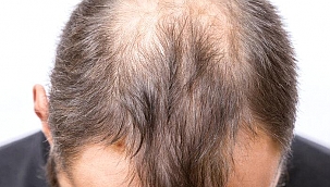 Erkeklerde saç dökülmesi nasıl durdurulur? Sadece 6 haftada...