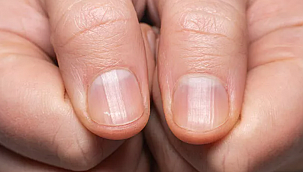 Sakın önemsiz görmeyin: Tırnağınızda görülen ufak değişikliklere dikkat! Tümör habercisi olabilir
