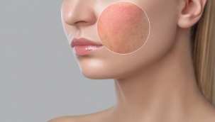 Sivilce izleri nasıl geçer? Sivilce izleri için maske ve krem önerileri