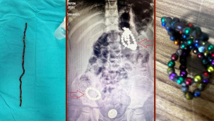 Bu oyuncak bir ölüm tuzağı! Herkesi çok şaşırtan vaka: 3 yaşında, karnında 66 adet mıknatısla aylarca yaşamış! Tehlikeye karşı uyarı: "İç organlarını deliyor"
